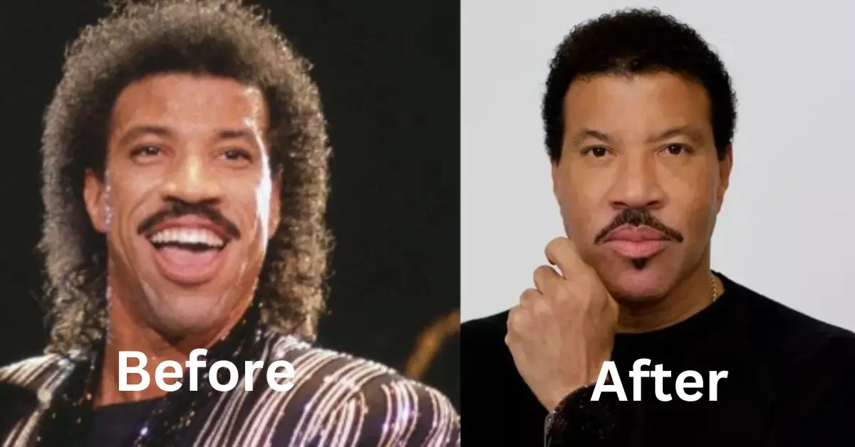 Did Lionel Richie Have Plastic Surgery? 