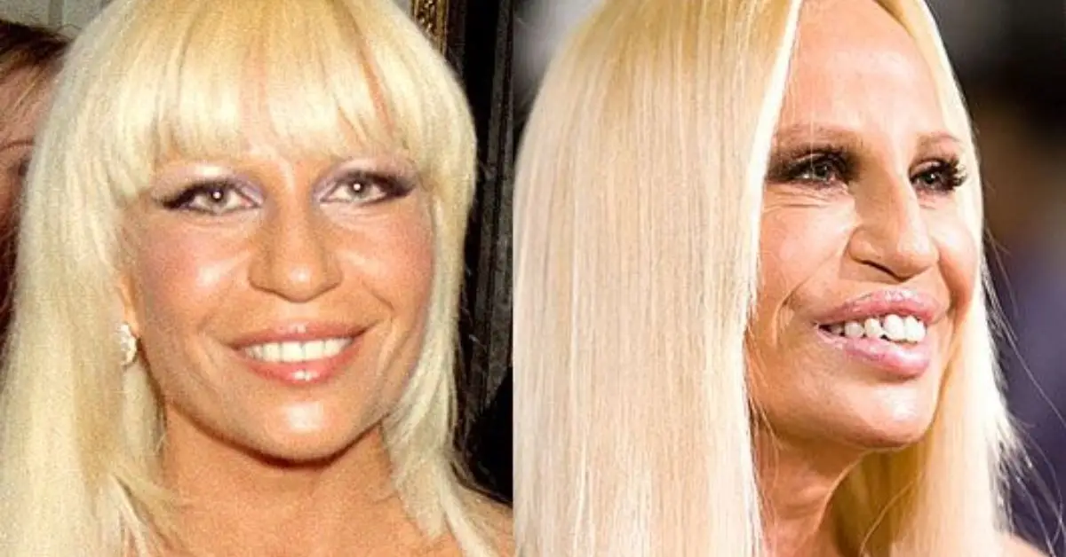 Donatella Versace Plastic Surgery
